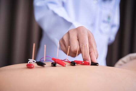 young woman undergoing acupuncture treatment with electrical stimulator on backの写真素材