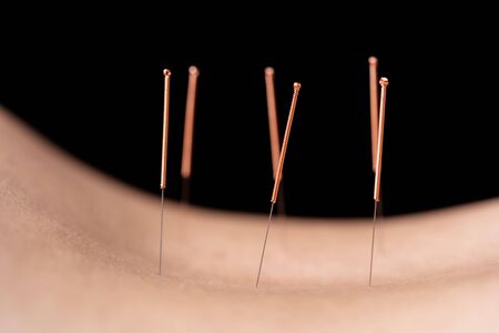 Close-up of female back with steel needles during procedure of the acupuncture therapy