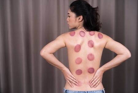 young woman receiving cupping treatment on backの写真素材