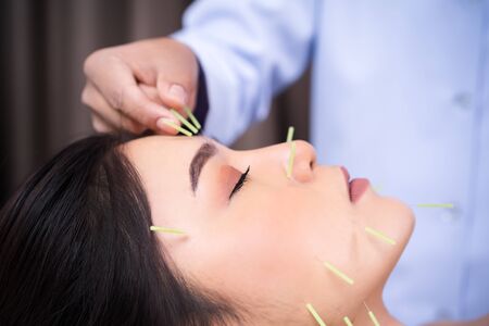 young woman undergoing acupuncture treatment on faceの写真素材