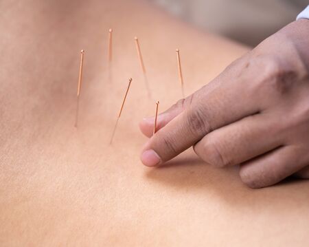 close up woman undergoing acupuncture treatment on backの写真素材