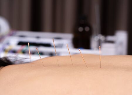 close up woman undergoing acupuncture treatment on backの写真素材