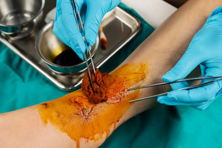 close up doctor cleaning wound on the leg, Injuries from falling