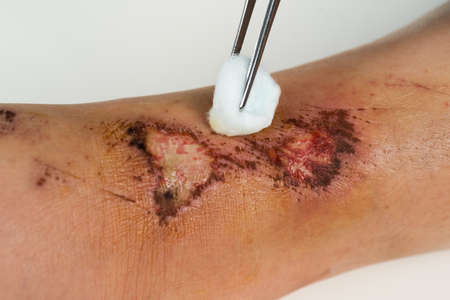 close up doctor cleaning wound on the leg, Injuries from fallingの写真素材