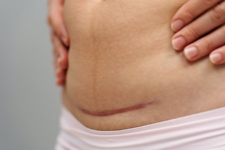 close up belly of woman with a c-section scar of caesareanの写真素材