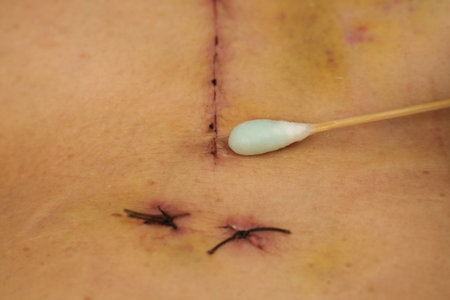 doctor using alcohol and cotton bud cleaning wound from open heart surgery on the female body (Heart Valve Regurgitation)の写真素材