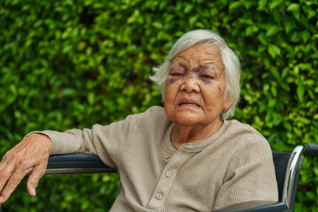 senior woman injury to the eyelid and nose swelling from an accidentの写真素材