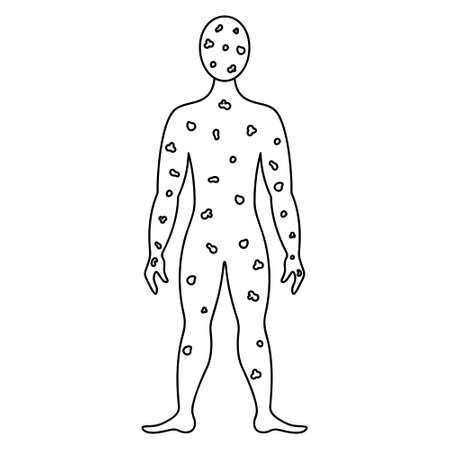 Smallpox on the human body. sketch. vector illustration. The patient's face and body are covered with spots. A muscular man in full height. Outline on an isolated background.のイラスト素材