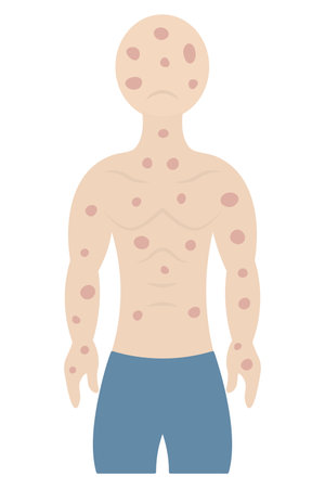 Rush on a human body. The patient's face and body are covered with pink spots. The muscular man is sad. Color vector illustration. Isolated on white background. Flat style. Medicalのイラスト素材