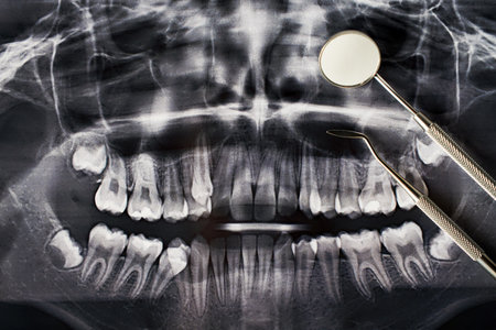 Dental x-ray and dentist tools, close-up. Panoramic x-ray radiograph of teeth for treatmentの写真素材