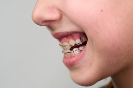 Little girl with teeth retainers looking at camera, close-up. Child with orthodontic plate or dental braces in her mouth. Children's dentistryの写真素材