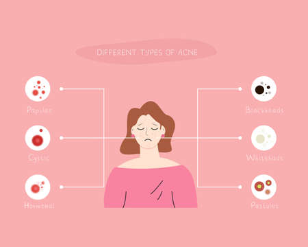 Different types of acne infographic illustrationのイラスト素材