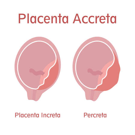 Types of placenta accreta: Placenta Increta and Percretaのイラスト素材