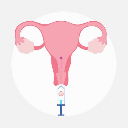 Frozen Embryo Transfer concept illustration