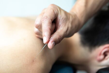 Handsome young man in an acupuncture therapyの写真素材