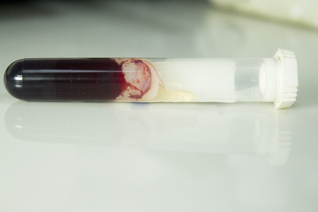 Vial of clotted blood. Red colour. Studio shot.の写真素材