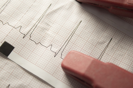 Close up of an electrocardiogram in paper form.
