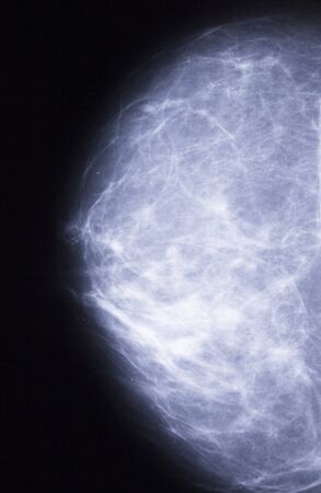 Female chest xray with cancerの写真素材