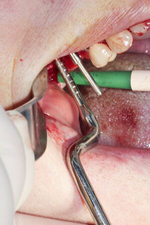 Real dental surgery in the molarsの写真素材