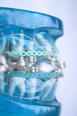 Denture for students with classic dental metal orthodontics. Color aesthetic couplings.