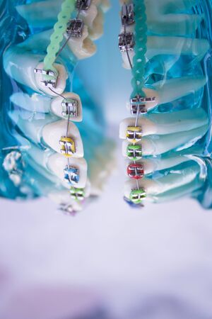Denture for students with classic dental metal orthodontics. Color aesthetic couplings.の写真素材