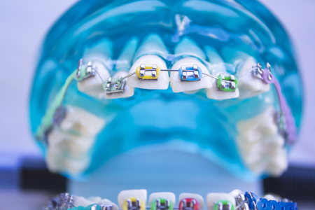 Denture for students with classic dental metal orthodontics. Color aesthetic couplings.の写真素材