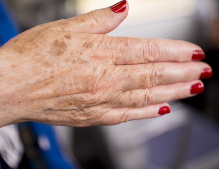 Hands of a middle aged woman with problems of rheumatism, osteoarthritis and skin blemishesの写真素材