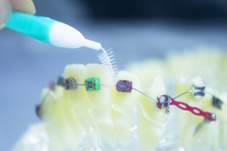 Model denture with metal orthodontics. No people