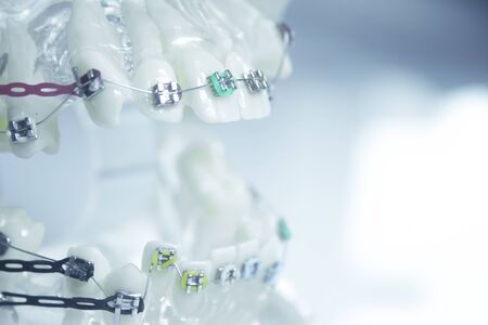 Model denture with metal orthodontics. No people