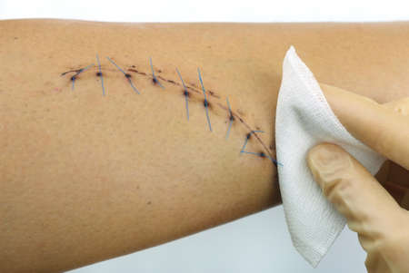 Closeup of a cleaning stitched wound on a male leg  10 stitches, 15 cm long 