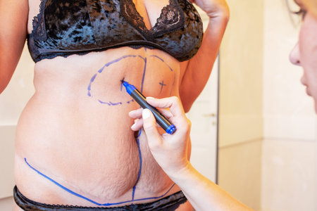 surgeon preparing woman for liposuction surgery