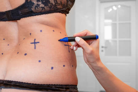 surgeon preparing woman for liposuction surgeryの写真素材