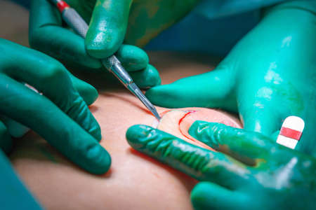 Surgeons team working with patient. breast augmentationの写真素材