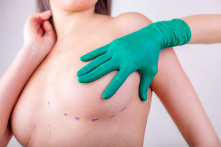 measurement of breast size for the selection of the implantの写真素材