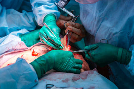 Surgical operation abdominoplastyの写真素材