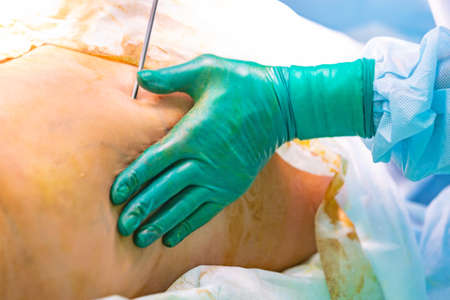 cosmetic liposuction surgery in actual operating room setting showing surgeon hands and cannulaの写真素材