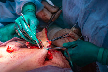 Surgical operation abdominoplastyの写真素材