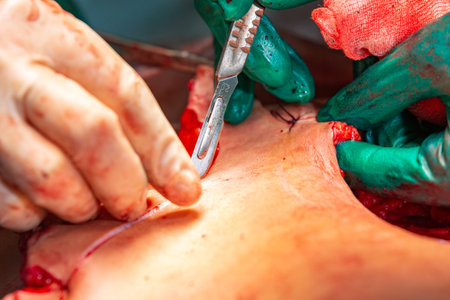 Surgical operation abdominoplasty