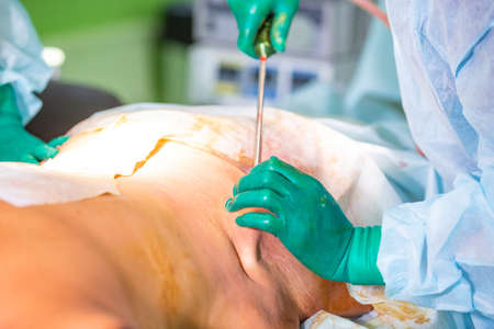 cosmetic liposuction surgery in actual operating room, group of surgeons working with cannulaの写真素材