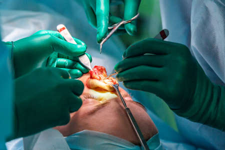 Surgeon and his assistant performing cosmetic surgery on nose in hospital operating room. Nose reshaping, augmentation. Rhinoplasty.の写真素材