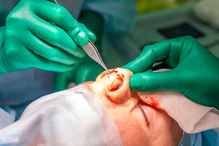 Surgeon and his assistant performing cosmetic surgery on nose in hospital operating room. Nose reshaping, augmentation. Rhinoplasty.の写真素材