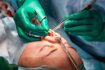 Surgeon and his assistant performing cosmetic surgery on nose in hospital operating room. Nose...
