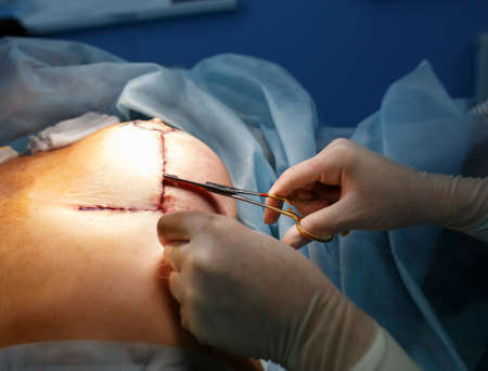 Operation close up. Breast augmentation surgery in the operating roomの写真素材