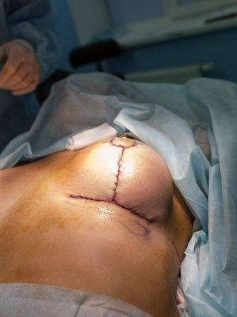 Operation close up. Breast augmentation surgery in the operating roomの写真素材