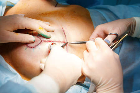 Operation close up. Breast augmentation surgery in the operating roomの写真素材