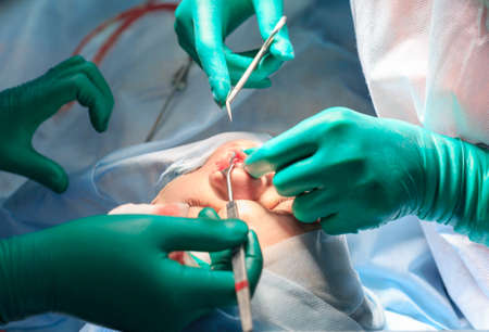 Plastic surgery of the nose in operating room, rhinoplastyの写真素材