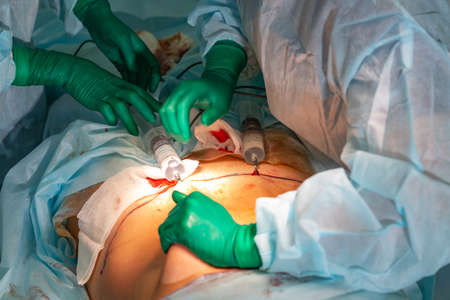 cosmetic liposuction surgery in actual operating room, group of surgeons working with cannulaの写真素材