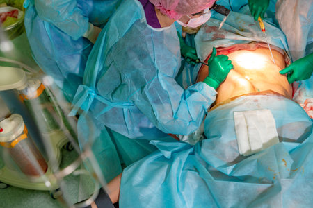 cosmetic liposuction surgery in actual operating room, group of surgeons working with cannula