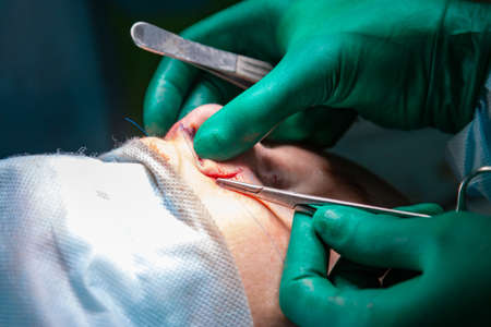 Surgeon and his assistant performing cosmetic surgery on nose in hospital operating room. Nose reshaping, augmentation. Rhinoplasty.の写真素材