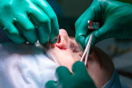 Surgeon and his assistant performing cosmetic surgery on nose in hospital operating room. Nose reshaping, augmentation. Rhinoplasty.の写真素材